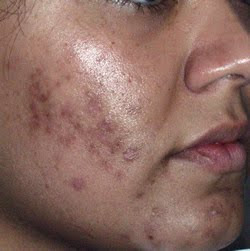 Opinion Acne facial seattle speaking Acne facial seattle opinion